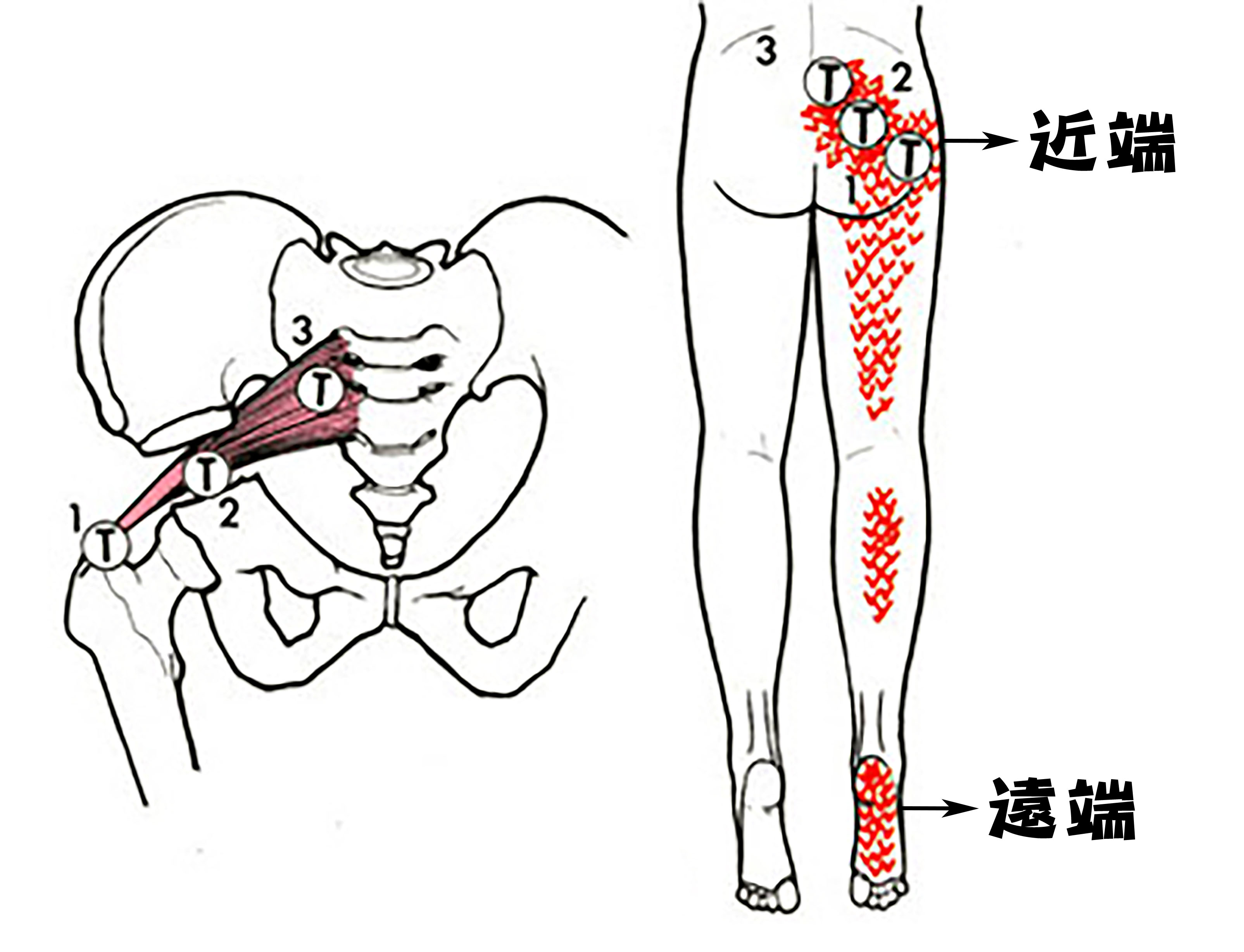 梨狀肌圖5.jpg