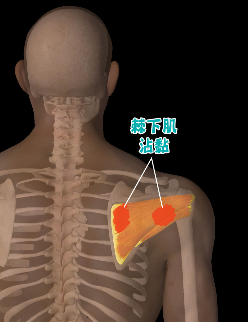 肩夾擠症候群_圖16.jpg