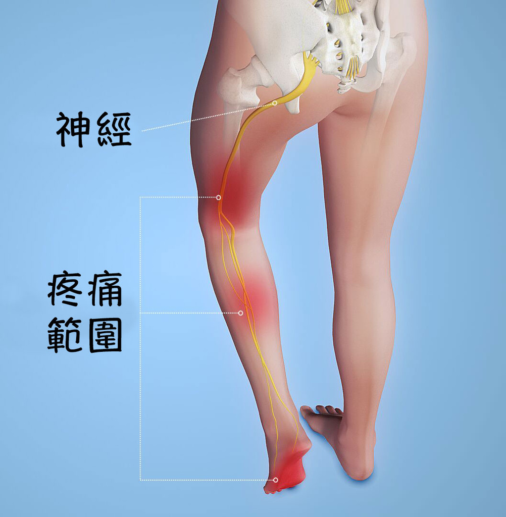 足底筋膜炎_圖11.jpg