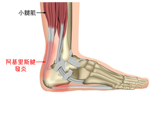 足底筋膜炎_圖15.jpg