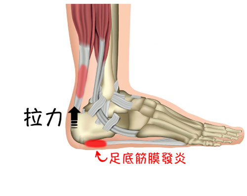 足底筋膜炎_圖6.jpg