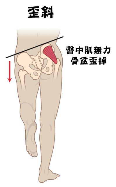 跑者膝_圖11.jpg