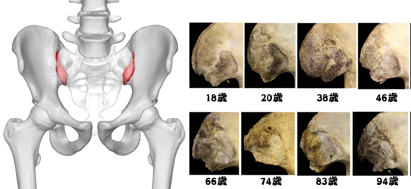 骨刺_圖12.jpg