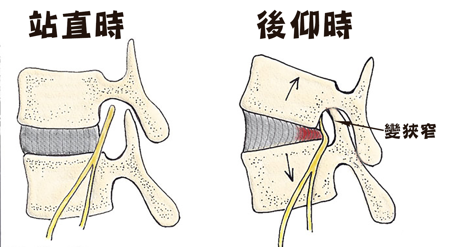 骨刺_圖25.jpg