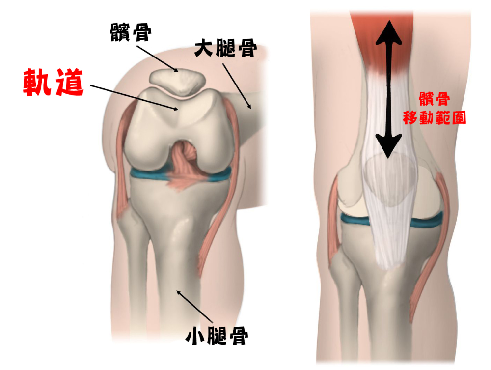 髕骨外翻_圖4.jpg