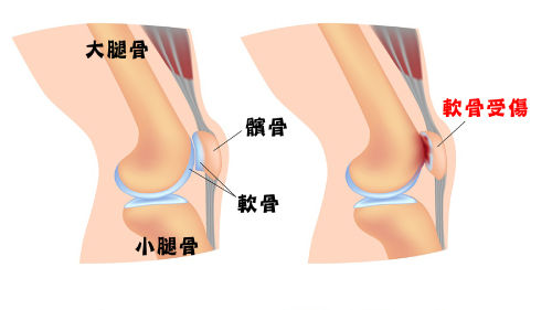 髕骨外翻_圖8.jpg